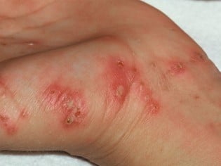 Slide show: Common skin rashes - Mayo Clinic