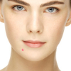 Types Of Acne