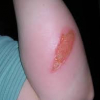 Types Of Burns Degrees