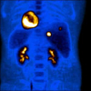 Types Of Rectal Tumors