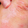 Types Of Skin Diseases