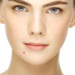 Types Of Acne