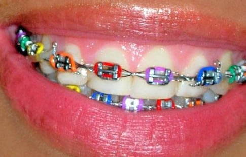 Types Of Braces For Teeth