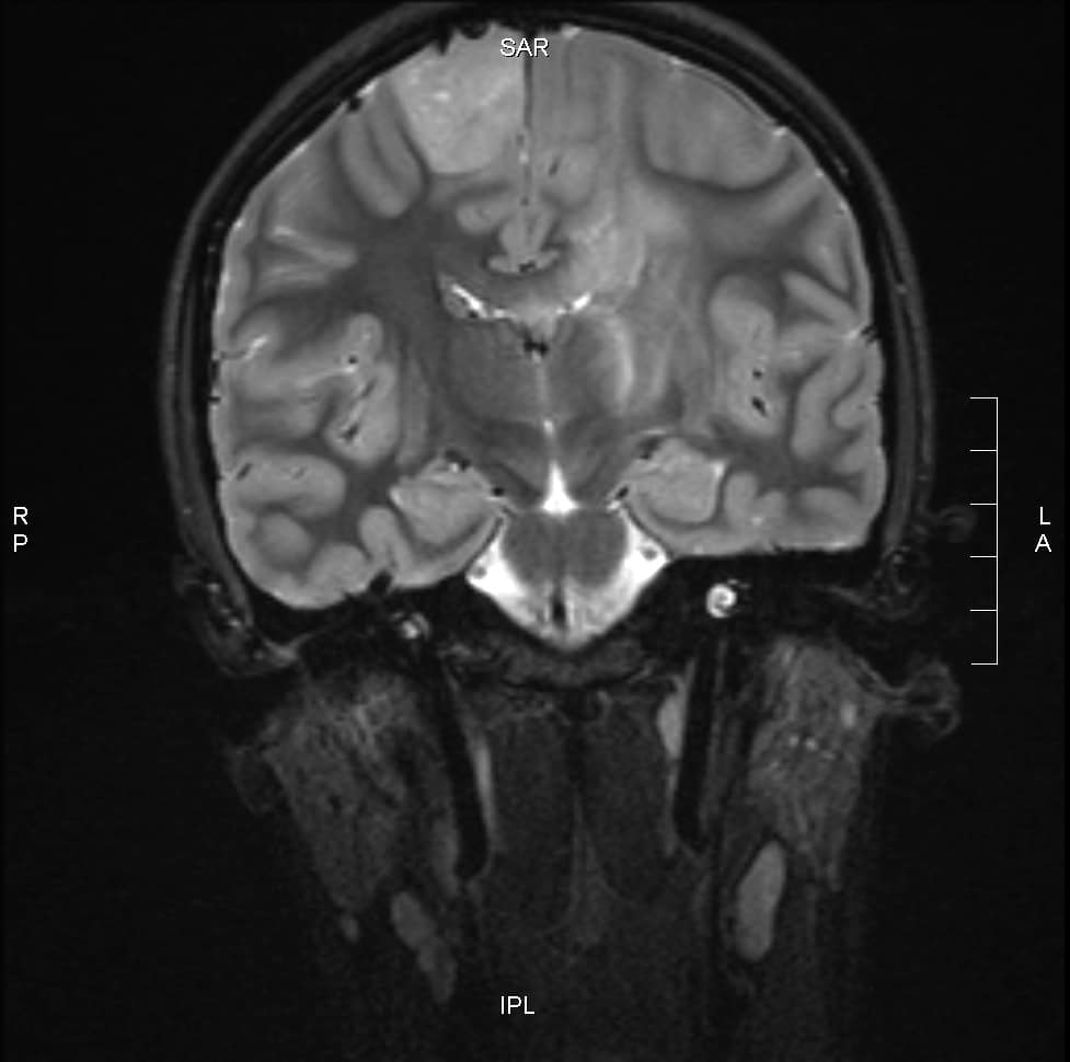 Types Of Brain Tumor