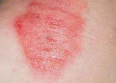 Types Of Eczema