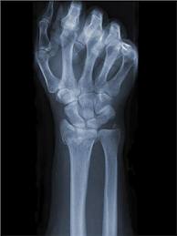 Types Of Fractures