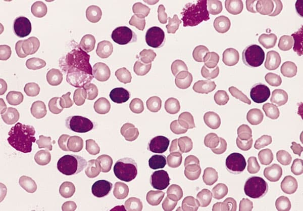 Types Of Leukemia