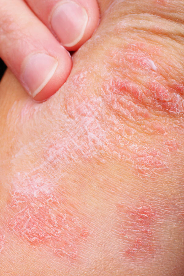 Types Of Skin Diseases