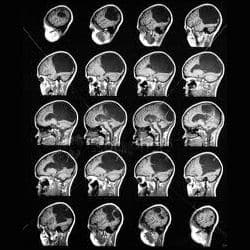 Types Of Tumors