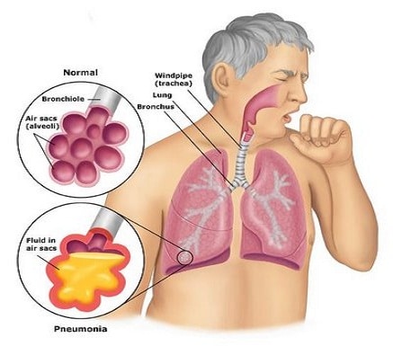 Types Of Pneumonia