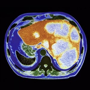 Types Of Liver Tumors