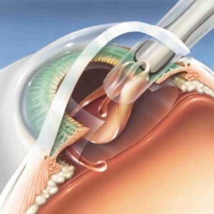 Types Of Cataracts