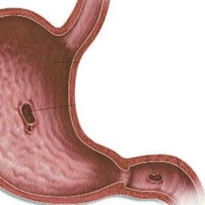 Types Of Gastric Tumors